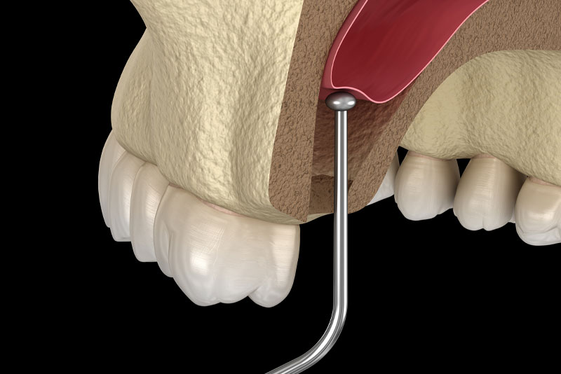 sinus lift graphic